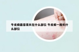 牛皮癣最容易长在什么部位 牛皮癣一般长什么部位