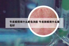 牛皮癣得用什么肥皂洗脸 牛皮肤癣用什么香皂好