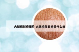 大腿根部癣图片 大腿根部长癣是什么癣