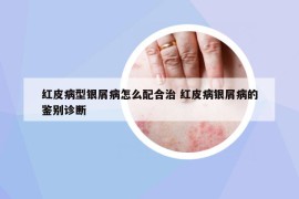 红皮病型银屑病怎么配合治 红皮病银屑病的鉴别诊断
