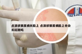 点滴状银屑病长脸上 点滴状银屑病脸上也会长红斑吗
