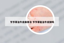 节节草治牛皮癣用法 节节草能治牛皮鲜吗