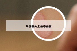 牛皮癣头上会不会有