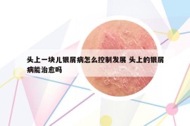 头上一块儿银屑病怎么控制发展 头上的银屑病能治愈吗