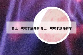 背上一块块干燥像癣 背上一块块干燥像癣痒