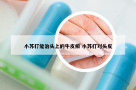 小苏打能治头上的牛皮癣 小苏打对头皮
