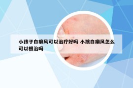 小孩子白癞风可以治疗好吗 小孩白癞风怎么可以根治吗