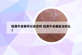 轻度牛皮癣可以自愈吗 轻度牛皮廨能治好么?
