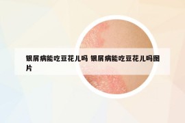 银屑病能吃豆花儿吗 银屑病能吃豆花儿吗图片