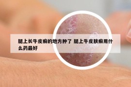 腿上长牛皮癣的地方肿了 腿上牛皮肤癣用什么药最好