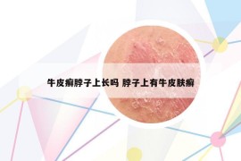 牛皮癣脖子上长吗 脖子上有牛皮肤癣