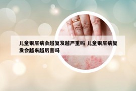 儿童银屑病会越复发越严重吗 儿童银屑病复发会越来越厉害吗