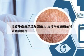 治疗牛皮癣风湿加盟东北 治疗牛皮病癣的特效药膏图片