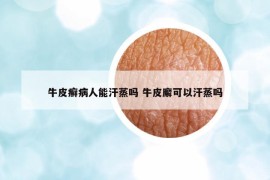 牛皮癣病人能汗蒸吗 牛皮廨可以汗蒸吗
