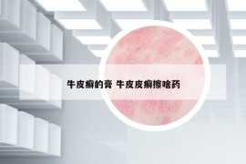牛皮癣的膏 牛皮皮癣擦啥药