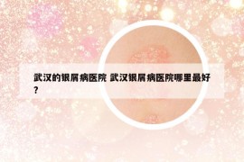 武汉的银屑病医院 武汉银屑病医院哪里最好?