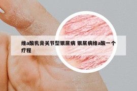 维a酸乳膏关节型银屑病 银屑病维a酸一个疗程