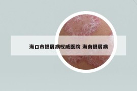 海口市银屑病权威医院 海南银屑病