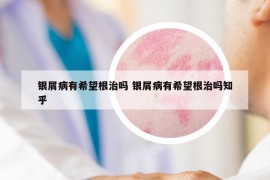 银屑病有希望根治吗 银屑病有希望根治吗知乎
