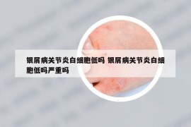 银屑病关节炎白细胞低吗 银屑病关节炎白细胞低吗严重吗