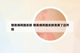 银屑病周围皮肤 银屑病周围皮肤变黑了还开裂
