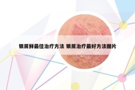银屑鲜最佳治疗方法 银屑治疗最好方法图片