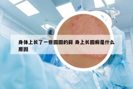 身体上长了一些圆圆的藓 身上长圆癣是什么原因