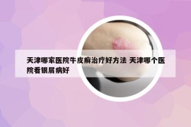 天津哪家医院牛皮癣治疗好方法 天津哪个医院看银屑病好