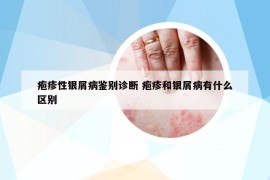 疱疹性银屑病鉴别诊断 疱疹和银屑病有什么区别