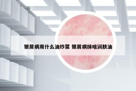 银屑病用什么油炒菜 银屑病抹啥润肤油