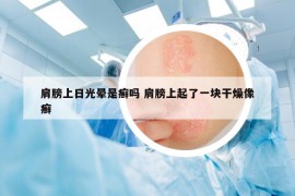 肩膀上日光晕是癣吗 肩膀上起了一块干燥像癣