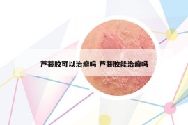 芦荟胶可以治癣吗 芦荟胶能治癣吗