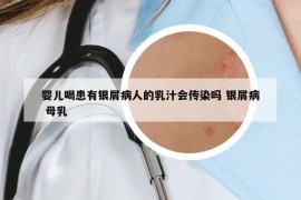 婴儿喝患有银屑病人的乳汁会传染吗 银屑病 母乳