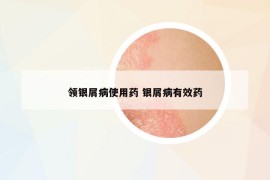 领银屑病使用药 银屑病有效药
