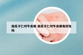 南瓜子仁对牛皮癣 南瓜子仁对牛皮癣有好处吗