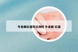 牛皮癣红酒可以渴吗 牛皮癣 红酒