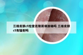 三维皮肤ct检查出银屑病准确吗 三维皮肤ct有辐射吗