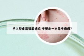 手上脱皮是银屑病吗 手脱皮一定是手癣吗?