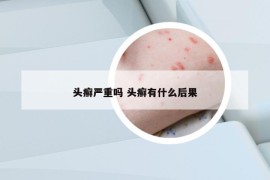 头癣严重吗 头癣有什么后果