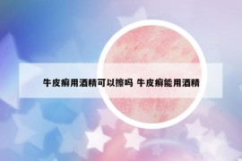 牛皮癣用酒精可以擦吗 牛皮癣能用酒精