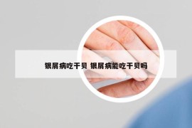 银屑病吃干贝 银屑病能吃干贝吗