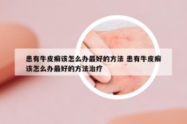 患有牛皮癣该怎么办最好的方法 患有牛皮癣该怎么办最好的方法治疗