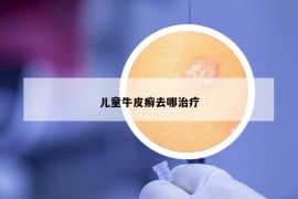 儿童牛皮癣去哪治疗