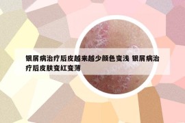 银屑病治疗后皮越来越少颜色变浅 银屑病治疗后皮肤变红变薄