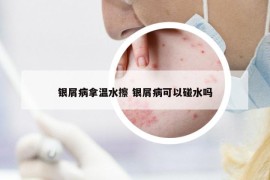 银屑病拿温水擦 银屑病可以碰水吗