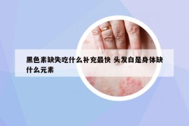 黑色素缺失吃什么补充最快 头发白是身体缺什么元素