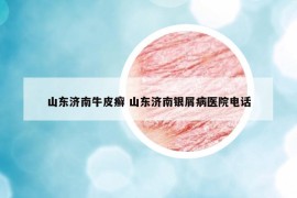 山东济南牛皮癣 山东济南银屑病医院电话