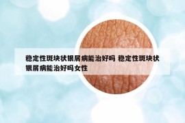 稳定性斑块状银屑病能治好吗 稳定性斑块状银屑病能治好吗女性