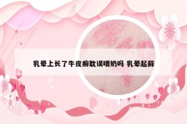 乳晕上长了牛皮癣耽误喂奶吗 乳晕起藓