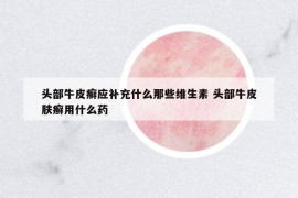 头部牛皮癣应补充什么那些维生素 头部牛皮肤癣用什么药